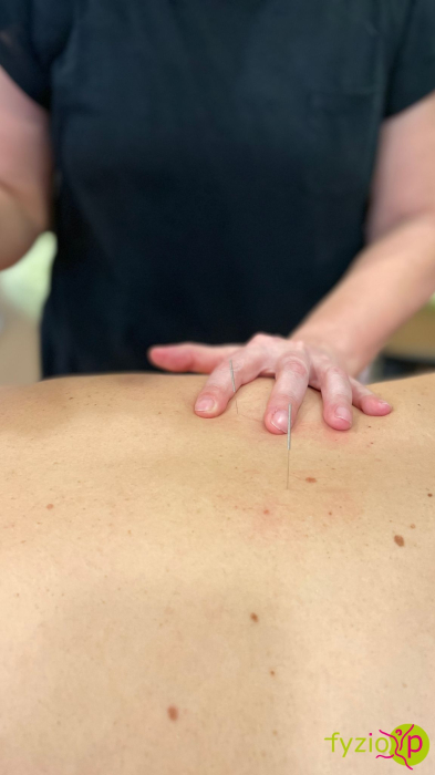 Diagnostika a terapie funkčních poruch metodou suché jehly pro pokročilé